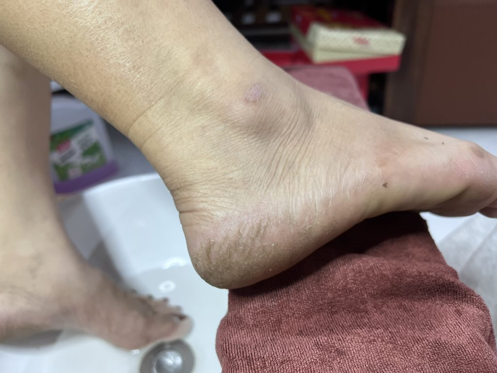 Chăm sóc gót chân khô nứt tại Kim Loan Beauty Hòa Thành Tây Ninh